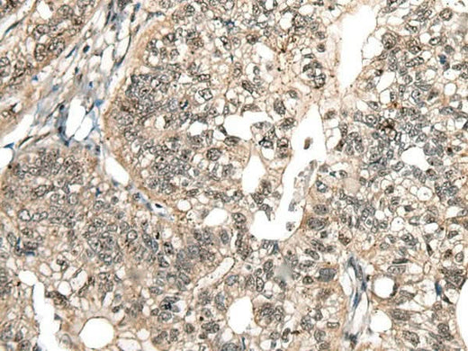 Immunohistochemistry of paraffin-embedded Human gastric cancer tissue using MCPH1 Polyclonal Antibody at dilution of 1:110(×200)
