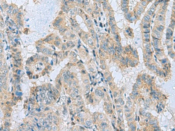 Immunohistochemistry of paraffin-embedded Human thyroid cancer tissue using MGME1 Polyclonal Antibody at dilution of 1:50(×200)