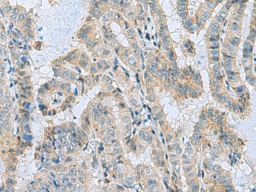 Immunohistochemistry of paraffin-embedded Human thyroid cancer tissue using MGME1 Polyclonal Antibody at dilution of 1:50(×200)