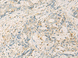 Immunohistochemistry of paraffin-embedded Human cervical cancer tissue using WDR37 Polyclonal Antibody at dilution of 1:50(×200)
