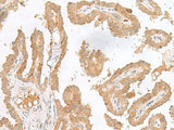 Immunohistochemistry of paraffin-embedded Human thyroid cancer tissue using CXCL6 Polyclonal Antibody at dilution of 1:45(×200)