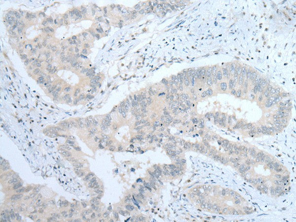 Immunohistochemistry of paraffin-embedded Human colorectal cancer tissue using ITGA8 Polyclonal Antibody at dilution of 1:30(×200)