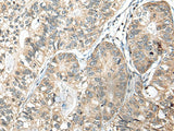 Immunohistochemistry of paraffin-embedded Human gastric cancer tissue using SLAMF7 Polyclonal Antibody at dilution of 1:30(×200)