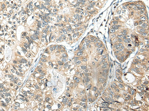 Immunohistochemistry of paraffin-embedded Human gastric cancer tissue using SLAMF7 Polyclonal Antibody at dilution of 1:30(×200)