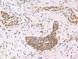 Immunohistochemistry of paraffin-embedded Human esophagus cancer tissue using CREBBP Polyclonal Antibody at dilution of 1:35(×200)