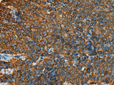 Immunohistochemistry of paraffin-embedded Human cervical cancer tissue using YBX1 Polyclonal Antibody at dilution of 1:25(×200)