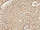 Immunohistochemistry of paraffin-embedded Human lung cancer tissue using USP21 Polyclonal Antibody at dilution of 1:50(×200)