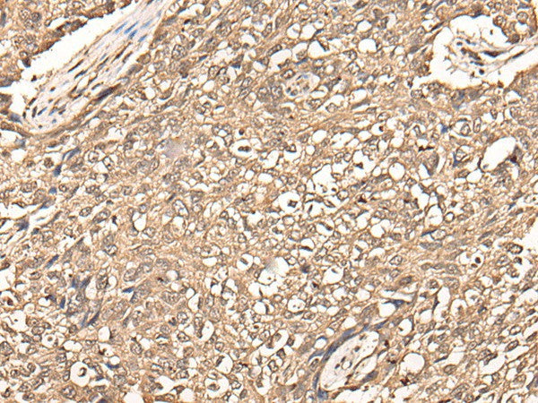 Immunohistochemistry of paraffin-embedded Human lung cancer tissue using USP21 Polyclonal Antibody at dilution of 1:50(×200)