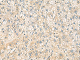 Immunohistochemistry of paraffin-embedded Human liver cancer tissue using PPM1M Polyclonal Antibody at dilution of 1:100(×200)