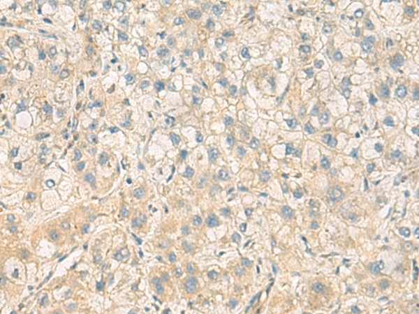 Immunohistochemistry of paraffin-embedded Human liver cancer tissue using PPM1M Polyclonal Antibody at dilution of 1:100(×200)