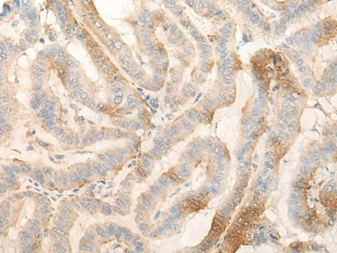Immunohistochemistry of paraffin-embedded Human thyroid cancer tissue using MPPED2 Polyclonal Antibody at dilution of 1:30(×200)