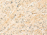 Immunohistochemistry of paraffin-embedded Human prost at e cancer tissue using EEF1AKMT2 Polyclonal Antibody at dilution of 1:50(×200)