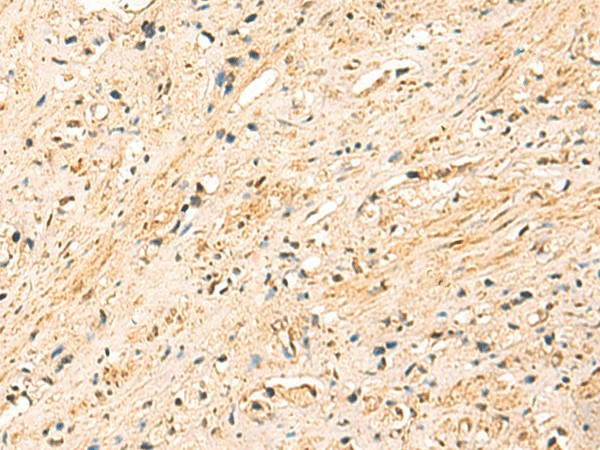 Immunohistochemistry of paraffin-embedded Human prost at e cancer tissue using EEF1AKMT2 Polyclonal Antibody at dilution of 1:50(×200)