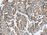 Immunohistochemistry of paraffin-embedded Human liver cancer tissue using PRELID3B Polyclonal Antibody at dilution of 1:90(×200)
