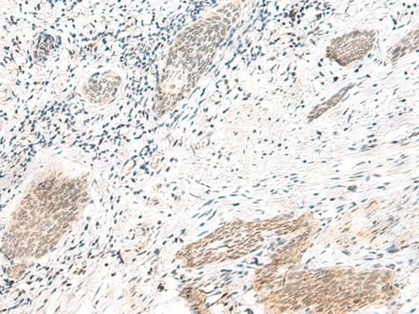 Immunohistochemistry of paraffin-embedded Human esophagus cancer tissue using ARL2BP Polyclonal Antibody at dilution of 1:50(×200)