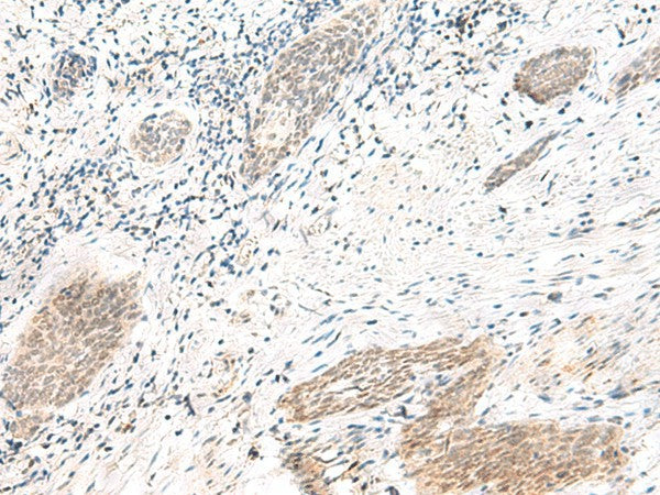 Immunohistochemistry of paraffin-embedded Human esophagus cancer tissue using ARL2BP Polyclonal Antibody at dilution of 1:50(×200)
