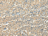 Immunohistochemistry of paraffin-embedded Human prost at e cancer tissue using CCDC112 Polyclonal Antibody at dilution of 1:45(×200)
