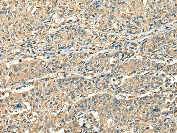 Immunohistochemistry of paraffin-embedded Human prost at e cancer tissue using CCDC112 Polyclonal Antibody at dilution of 1:45(×200)
