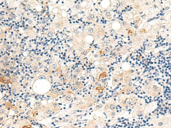 Immunohistochemistry of paraffin-embedded Human liver cancer tissue using DUT Polyclonal Antibody at dilution of 1:60(×200)