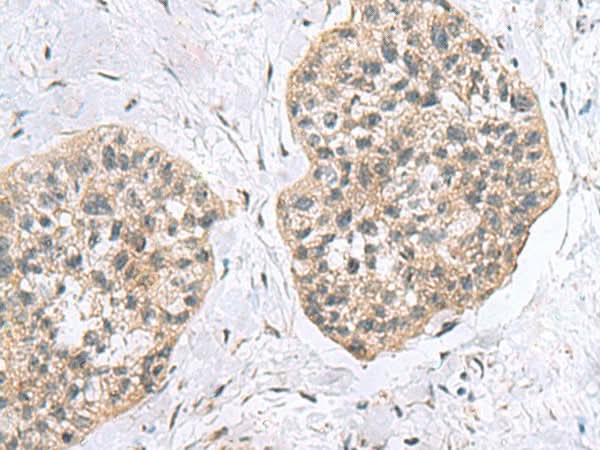 Immunohistochemistry of paraffin-embedded Human esophagus cancer tissue using RPL18 Polyclonal Antibody at dilution of 1:60(×200)