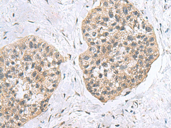 Immunohistochemistry of paraffin-embedded Human esophagus cancer tissue using RPL18 Polyclonal Antibody at dilution of 1:60(×200)