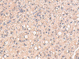 Immunohistochemistry of paraffin-embedded Human liver cancer tissue using RIOK1 Polyclonal Antibody at dilution of 1:80(×200)