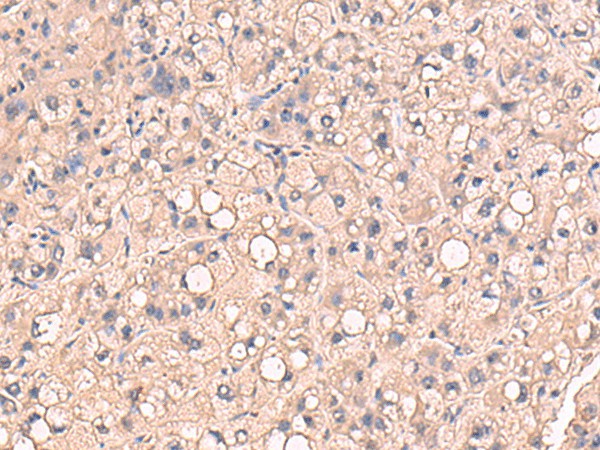 Immunohistochemistry of paraffin-embedded Human liver cancer tissue using RIOK1 Polyclonal Antibody at dilution of 1:80(×200)