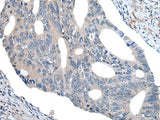 Immunohistochemistry of paraffin-embedded Human colorectal cancer tissue using UBR4 Polyclonal Antibody at dilution of 1:55(×200)