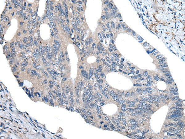 Immunohistochemistry of paraffin-embedded Human colorectal cancer tissue using UBR4 Polyclonal Antibody at dilution of 1:55(×200)