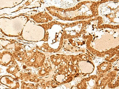 Immunohistochemistry of paraffin-embedded Human thyroid cancer tissue using GTF3C3 Polyclonal Antibody at dilution of 1:30(×200)