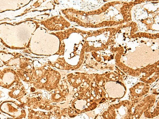 Immunohistochemistry of paraffin-embedded Human thyroid cancer tissue using GTF3C3 Polyclonal Antibody at dilution of 1:30(×200)