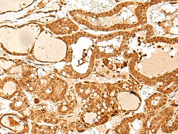 Immunohistochemistry of paraffin-embedded Human thyroid cancer tissue using GTF3C3 Polyclonal Antibody at dilution of 1:30(×200)
