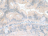 Immunohistochemistry of paraffin-embedded Human colorectal cancer tissue using UBE2F Polyclonal Antibody at dilution of 1:70(×200)