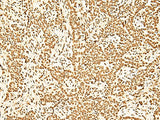 Immunohistochemistry of paraffin-embedded Human ovarian cancer tissue using ILF3 Polyclonal Antibody at dilution of 1:60(×200)