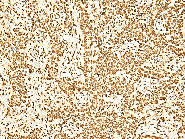 Immunohistochemistry of paraffin-embedded Human ovarian cancer tissue using ILF3 Polyclonal Antibody at dilution of 1:60(×200)