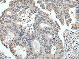 Immunohistochemistry of paraffin-embedded Human colorectal cancer tissue using TRIM23 Polyclonal Antibody at dilution of 1:55(×200)