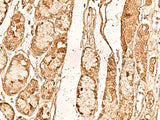 Immunohistochemistry of paraffin-embedded Human liver cancer tissue using WDR33 Polyclonal Antibody at dilution of 1:65(×200)