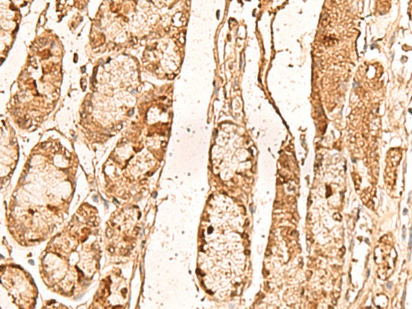 Immunohistochemistry of paraffin-embedded Human liver cancer tissue using WDR33 Polyclonal Antibody at dilution of 1:65(×200)