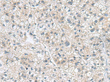 Immunohistochemistry of paraffin-embedded Human liver cancer tissue using GEMIN7 Polyclonal Antibody at dilution of 1:70(×200)
