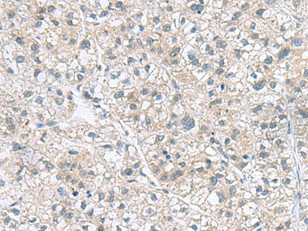 Immunohistochemistry of paraffin-embedded Human liver cancer tissue using GEMIN7 Polyclonal Antibody at dilution of 1:70(×200)