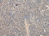 Immunohistochemistry of paraffin-embedded Human liver cancer tissue using ATAD1 Polyclonal Antibody at dilution of 1:50(×200)