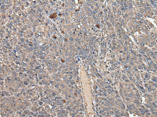 Immunohistochemistry of paraffin-embedded Human liver cancer tissue using ATAD1 Polyclonal Antibody at dilution of 1:50(×200)