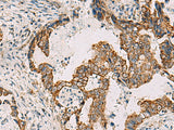 Immunohistochemistry of paraffin-embedded Human cervical cancer tissue using PDHA1 Polyclonal Antibody at dilution of 1:50(×200)