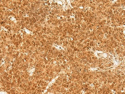 Immunohistochemistry of paraffin-embedded Human ovarian cancer tissue using TOR1A Polyclonal Antibody at dilution of 1:30(×200)