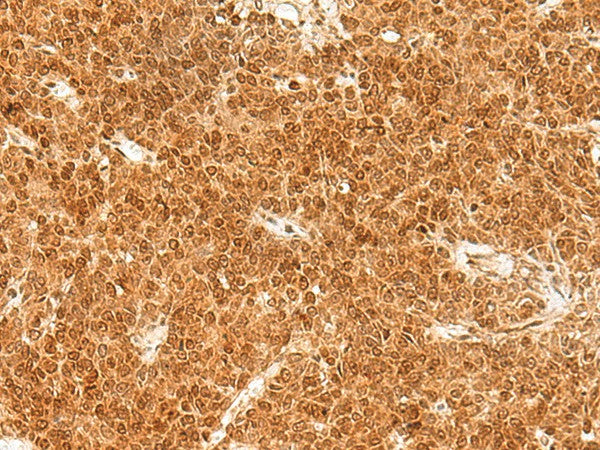 Immunohistochemistry of paraffin-embedded Human ovarian cancer tissue using TOR1A Polyclonal Antibody at dilution of 1:30(×200)