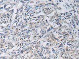 Immunohistochemistry of paraffin-embedded Human gastric cancer tissue using KCNJ10 Polyclonal Antibody at dilution of 1:60(×200)
