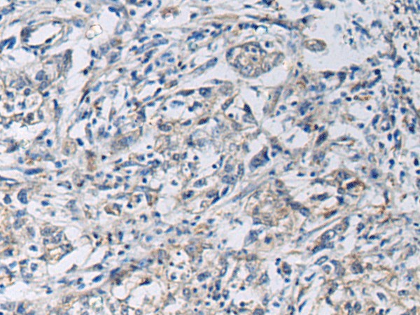 Immunohistochemistry of paraffin-embedded Human gastric cancer tissue using KCNJ10 Polyclonal Antibody at dilution of 1:60(×200)