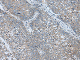 Immunohistochemistry of paraffin-embedded Human liver cancer tissue using BICD2 Polyclonal Antibody at dilution of 1:70(×200)