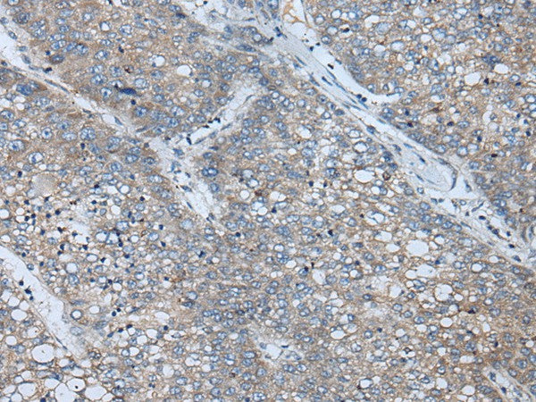 Immunohistochemistry of paraffin-embedded Human liver cancer tissue using BICD2 Polyclonal Antibody at dilution of 1:70(×200)