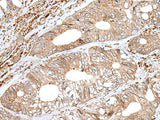 Immunohistochemistry of paraffin-embedded Human colorectal cancer tissue using ENPEP Polyclonal Antibody at dilution of 1:65(×200)